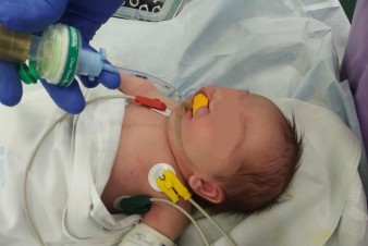 Nová intubační pomůcka pro děti s rozštěpem